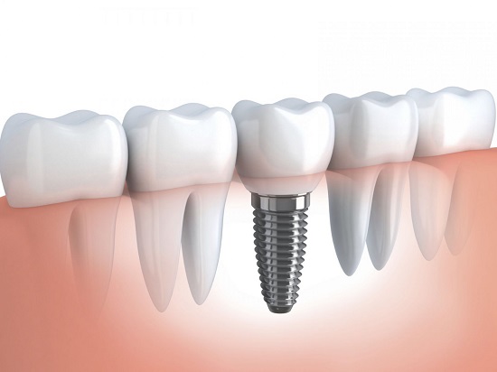 Răng implant có bền không? 1