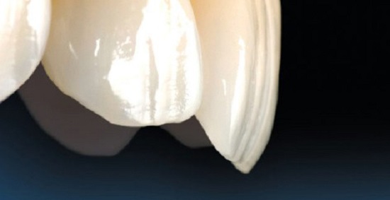 Răng implant có bền không? 3