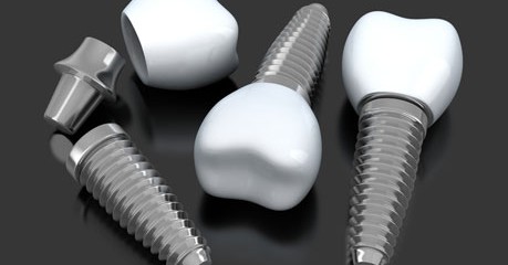 Thông tin cần biết khi lựa chọn trồng răng implant 1