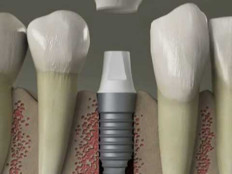 Thông tin cần biết khi lựa chọn trồng răng implant 2