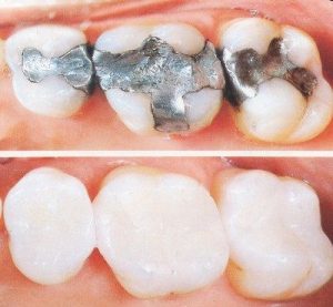 Trám răng Composite có duy trì lâu dài được không? 2