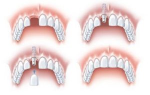 Trồng răng implant có đau không? 2