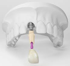 Trồng răng implant và những câu hỏi thắc mắc