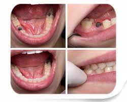 Trồng răng implant nha khoa và những câu hỏi thắc mắc 2