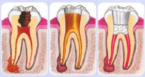 Viêm tủy do sâu răng có phục hồi được không? 1