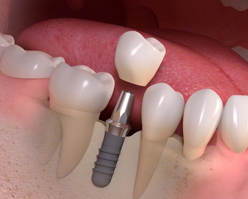 Sự khác biệt giữa làm răng cố định và tháo lắp 1