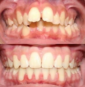 Tại sao có trường hợp cần nhổ răng khi niềng răng? 1