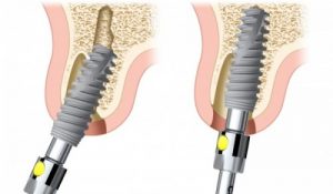 Trụ implant có thể sử dụng suốt đời