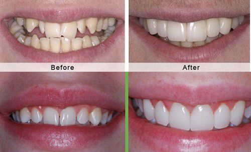 Bọc răng sứ có ảnh hưởng tốt hay xấu?