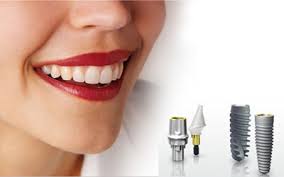 Cấy implant có thể áp dụng mất một hoặc nhiều răng 1