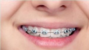 Chế độ chăm sóc trong quá trình niềng răng thẩm mỹ 1