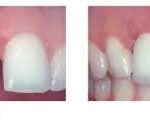 Điểm mặt những yếu tố làm ảnh hưởng chi phí trồng răng implant