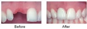 Điểm mặt những yếu tố làm ảnh hưởng chi phí trồng răng implant