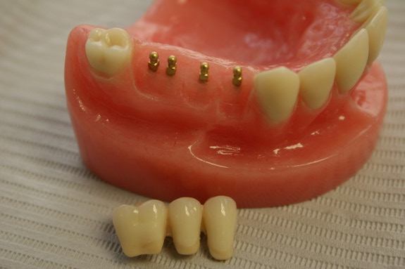 Điểm mặt những yếu tố làm ảnh hưởng chi phí trồng răng implant 2
