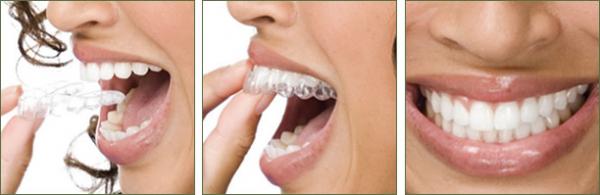 Giải pháp niềng răng giúp bạn luôn tự tin khi giao tiếp 2 Giải pháp niềng răng giúp bạn luôn tự tin khi giao tiếp 2