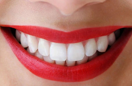 Giải pháp tối ưu nhất để sở hữu hàm răng trắng đều 2