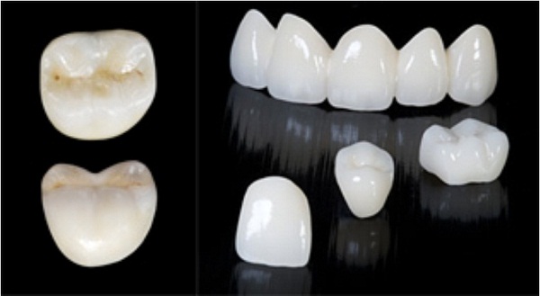 Nên chọn răng sứ loại nào để phục hình răng hư tủy? 2