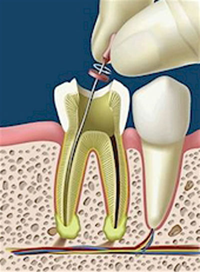 Nên chọn răng sứ loại nào để phục hình răng hư tủy? 1