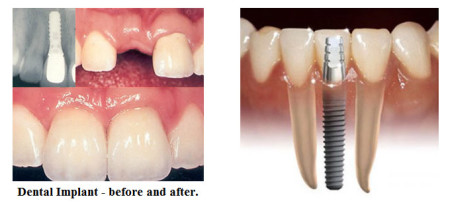 Những đặc tính của răng giả implant 1