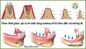 Những điều cần biết về ghép xương hàm