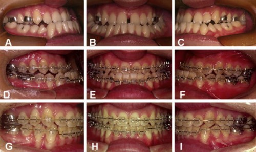 Những khuyết điểm răng không thẳng đều và cách cải thiện 2