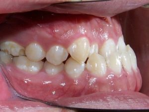 Những khuyết điểm răng không thẳng đều và cách cải thiện
