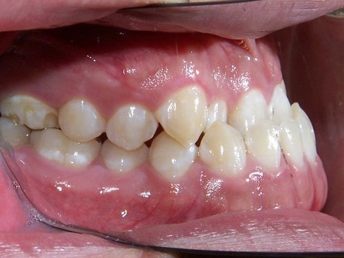 Những khuyết điểm răng không thẳng đều và cách cải thiện 1