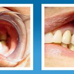 Những trở ngại khi cấy ghép implant
