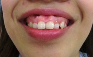 Niềng răng có hết hô không ?