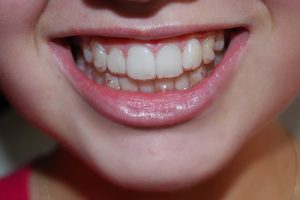 Niềng răng có kết hợp phẫu thuật hàm được không