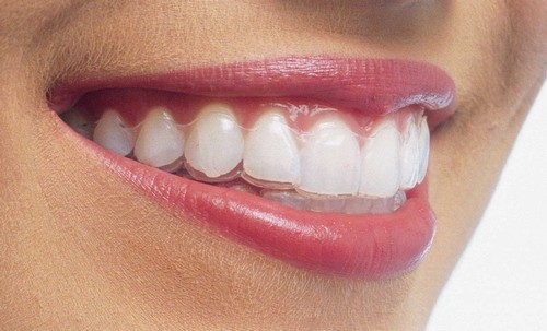 Tại sao niềng răng invisalign có chi phí cao? 2