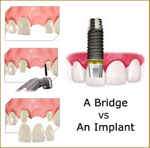 Tầm quan trọng của implant nha khoa đối với bệnh nhân mất răng