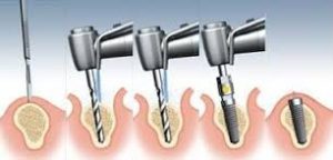 Tầm quan trọng của implant nha khoa đối với bệnh nhân mất răng 2