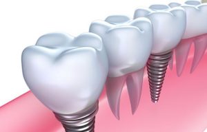 Tất tần tật thông tin về chi phí trồng răng implant hiện nay