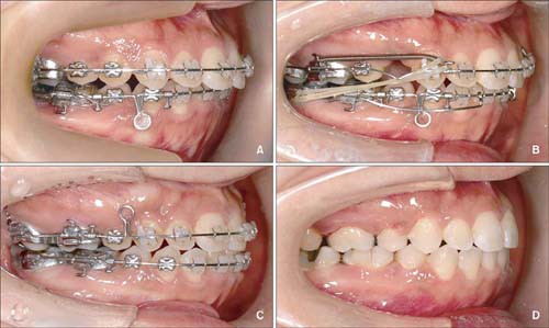 Điều trị răng hô như thế nào cho đúng? 2