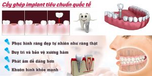 Ưu điểm khi cấy ghép răng implant
