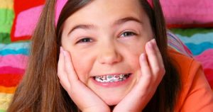Những điều cần biết về niềng răng cho trẻ em
