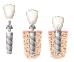 Cắm implant răng cửa như thế nào? 1