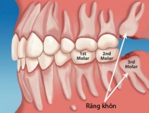 Đau răng khôn – Nguyên nhân và cách xử lý 1