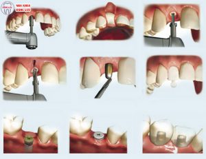 Nên bọc răng sứ hay cấy ghép implant? 2