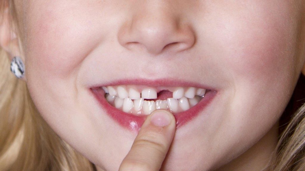 Nên bọc răng sứ hay cấy ghép implant? 3