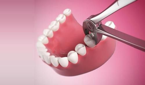Răng khôn mọc lệch có nên nhổ không? 2