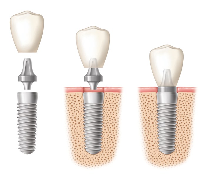 Quá trình cấy ghép implant cho răng hàm 1