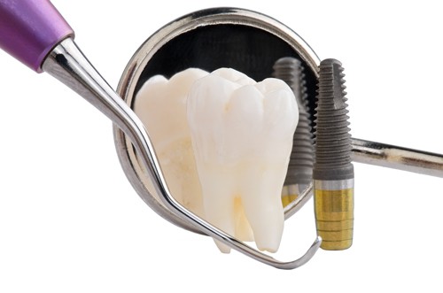 Quy trình cấy ghép răng implant hiệu quả cao 3