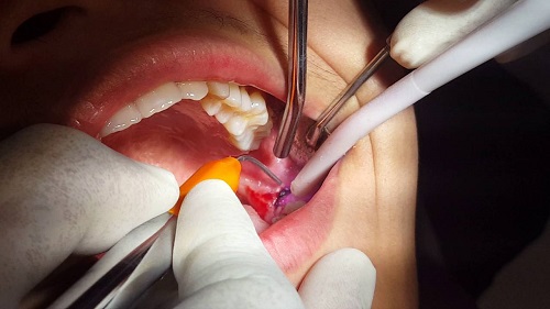 Cắt lợi trùm răng khôn có đau không? Phương pháp thực hiện 2