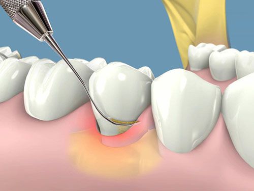 Lấy cao răng có ảnh hưởng không? Cần tư vấn gấp 2