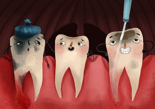 Cao răng nhiều lấy cao răng có đau hay không? 1