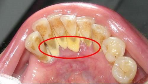 Cao răng nhiều lấy cao răng có đau hay không? 2