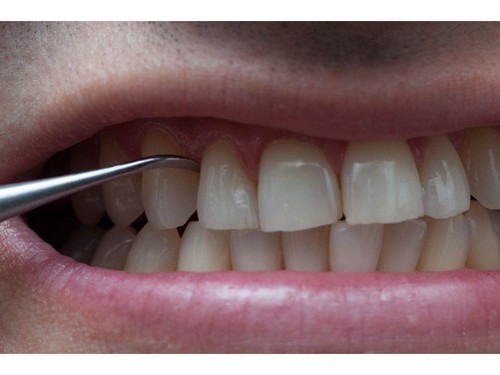 Lấy cao răng ở đâu an toàn và hiệu quả? 1