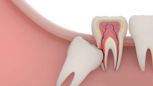 Nhổ răng khôn hàm dưới có nguy hiểm không? 1